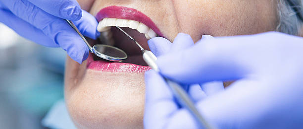 Best Emergency Tooth Extraction in Orida Gulf Coast University, FL